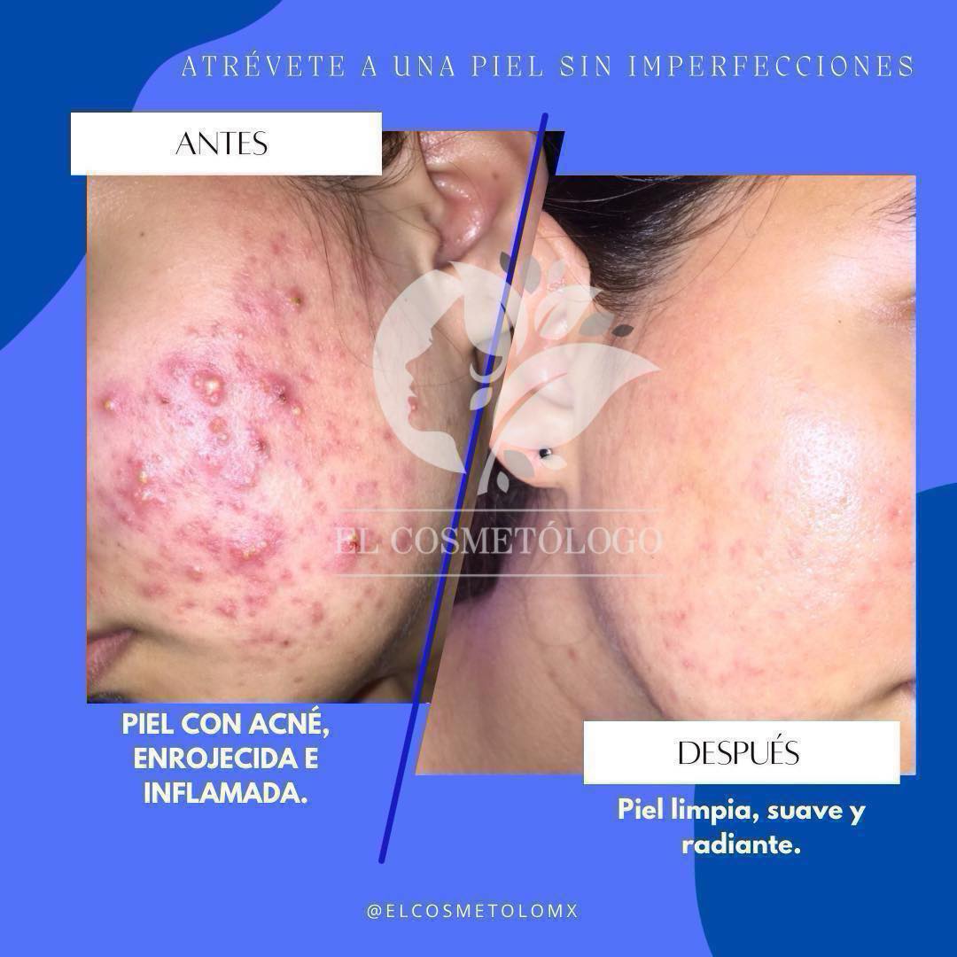 Tratamientos para acné