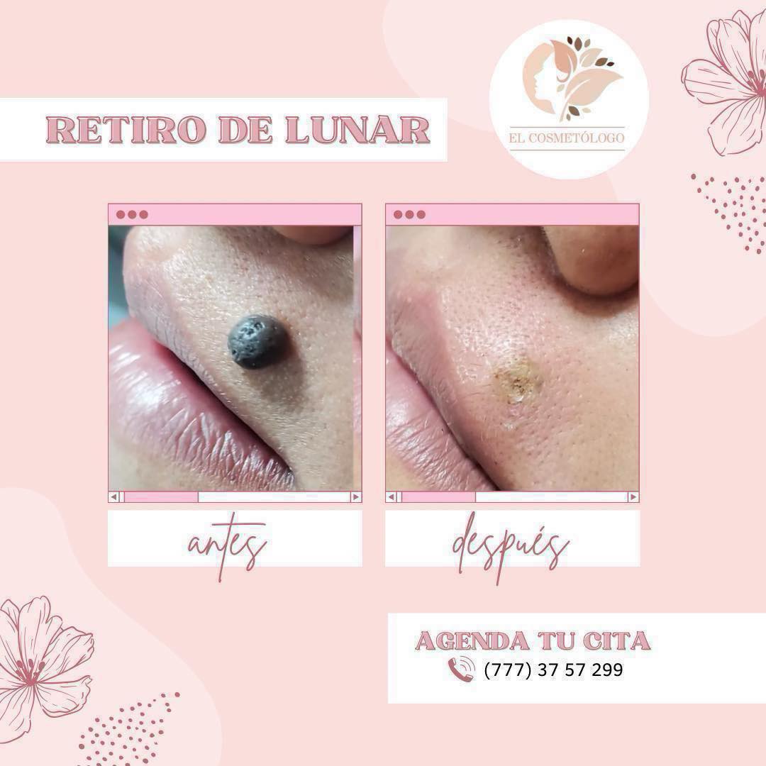 Retiro de lunar - antes y después